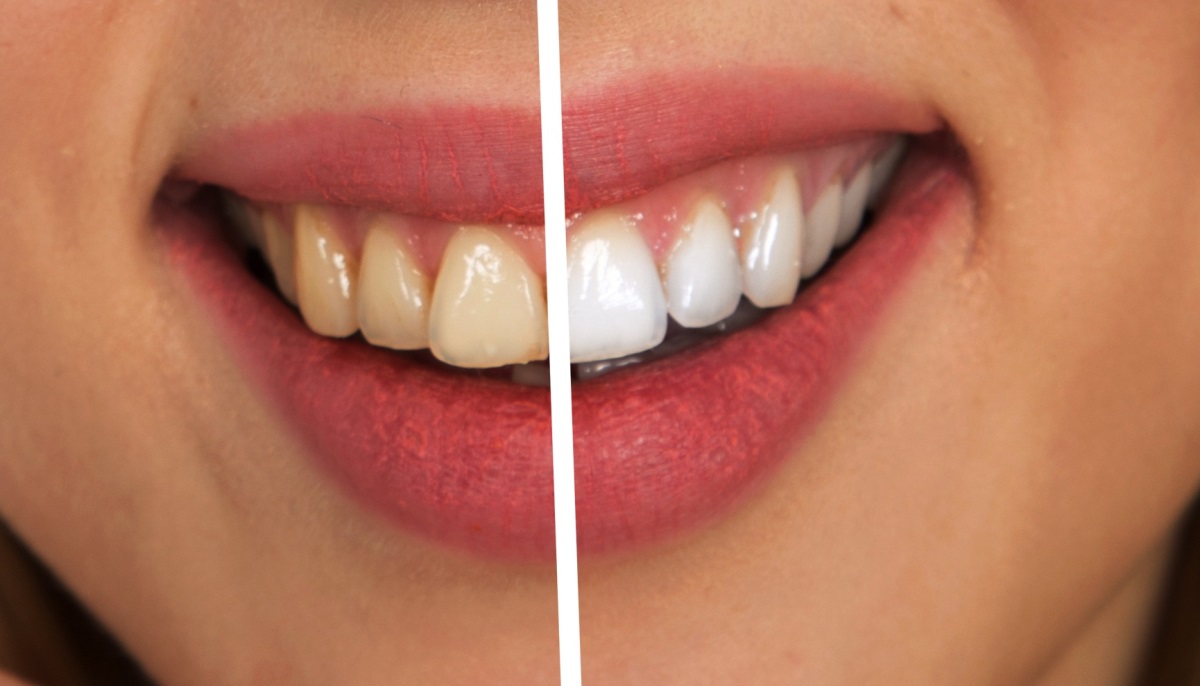 teeth_whitening_Port_Moody_dentist