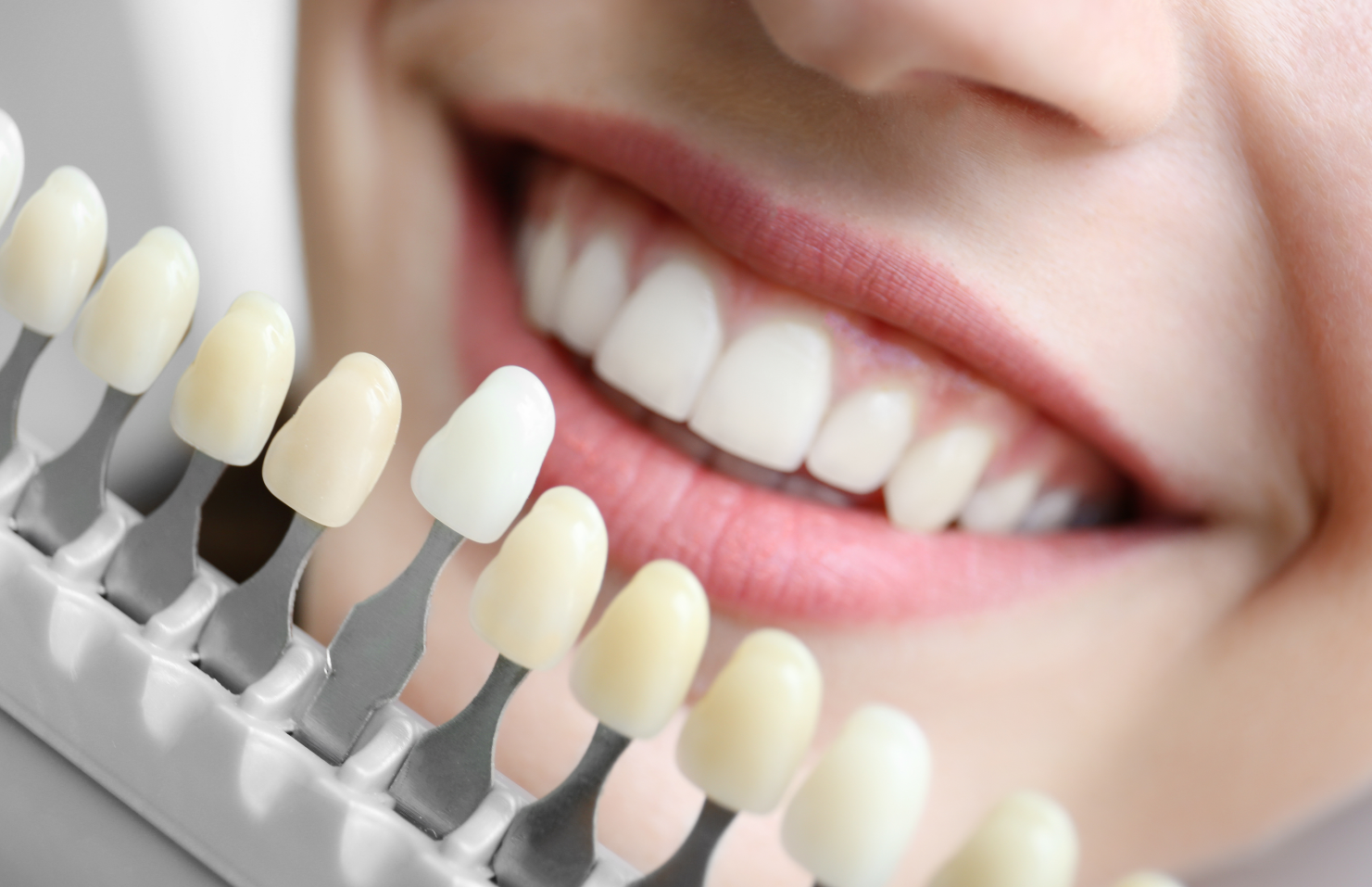 tooth_whitening_Port_Moody_dentist